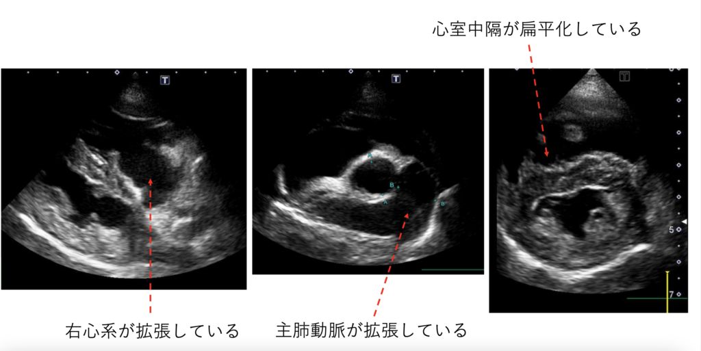 肺高血圧症患者の見通し